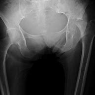 Image result for Hip Joint Space Narrowing