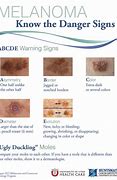 Image result for 5 Warning Signs of Skin Cancer