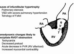 Image result for Right Ventricular Outflow Tract