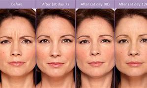 Image result for Day After Botox