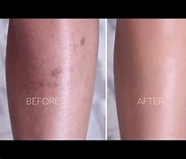 Image result for Dark Pigmentation On Legs