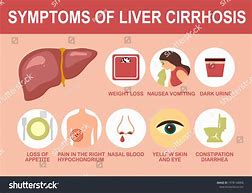 Image result for Early Symptoms Cirrhosis Liver