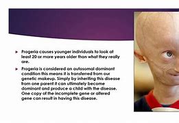 Image result for Progeria