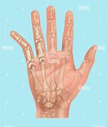 Image result for Dislocated Pinky Finger