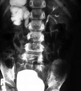 Image result for J-shaped Ureter