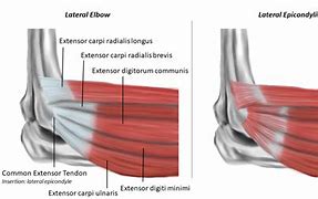 Image result for Common Extensor Tendon Anatomy