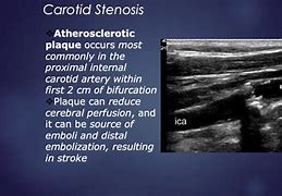 Image result for Stenosis