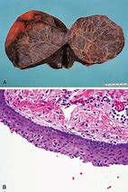 Image result for Cyst On Spleen