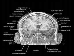 Image result for Coronal Plane Brain MRI