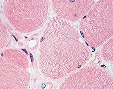 Image result for Tetano Muscolare