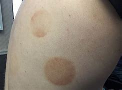 Image result for Raised Circular Lesion On Skin