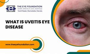 Image result for Uveitis Eye Disease