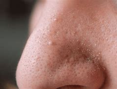 Image result for Open Nose Pores