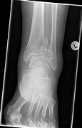 Image result for Surgical Approach of Pilon Fracture