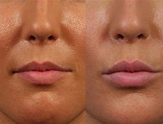 Image result for Bad Lip Fillers