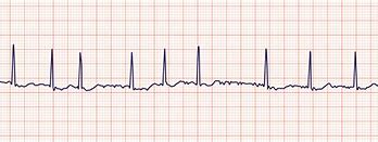 Image result for Ventricular Flutter and Fibrillation