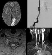 Image result for Vertebral Dissection On Angiogram