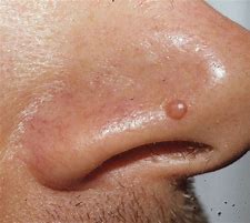 Image result for Papule Pimple