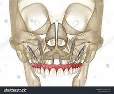 Image result for Zygomatic Implants in Maxillofacial Prosthesis