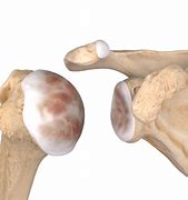 Image result for Arthritc Shoulder