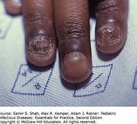 Image result for HIV Bumps On Fingers