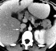 Image result for Large Pheochromocytoma CT