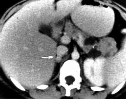 Image result for Pheochromocytoma On CT Scan