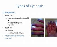 Image result for Cyanosis Legs