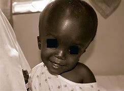 Image result for Hydrocephalus