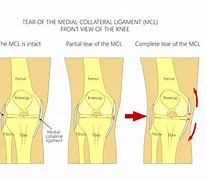 Image result for ACL MCL Meniscus