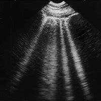 Image result for B Lines Chest Ultrasound