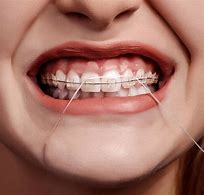 Image result for Fixed Braces Teeth Side View