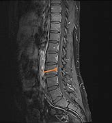 Image result for Lumbar Spine MRI Meme