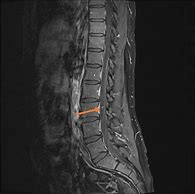 Image result for Lumbar Spine MRI 8Mm