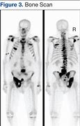 Image result for DDR and Bone Metastasis