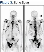 Image result for DDR and Bone Metastasis