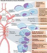 Image result for Acral Ischemia