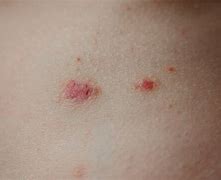 Image result for Clobetasol and Skin Atrophy