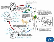 Image result for Dracunculiasis Treatment