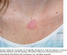 Image result for Raised Circular Lesion On Skin