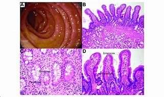 Image result for Duodenal Mucosa