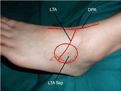 Image result for Dorsal Pedal Artery Anatomy