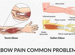 Image result for Outer Elbow Pain