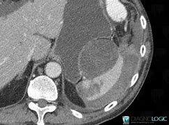 Image result for Spleen Metastasis