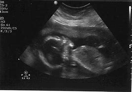 Image result for Male Baby Ultrasound