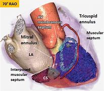 Image result for Atrioventricular Septum