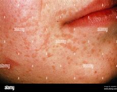 Image result for Plane Warts