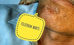 Image result for Filiform Wart On Finger