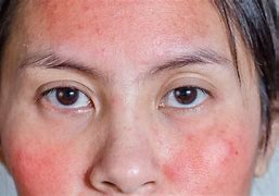 Image result for High Blood Pressure Red Face