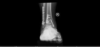 Image result for Surgery for Closed Trimalleolar Ankle Fracture